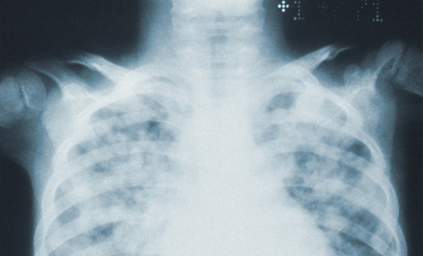 Episode 56: Lung Cancer in Non-Smokers Linked To Oral Microbiome